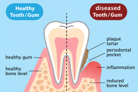Gum Disease / Periodontal Disease